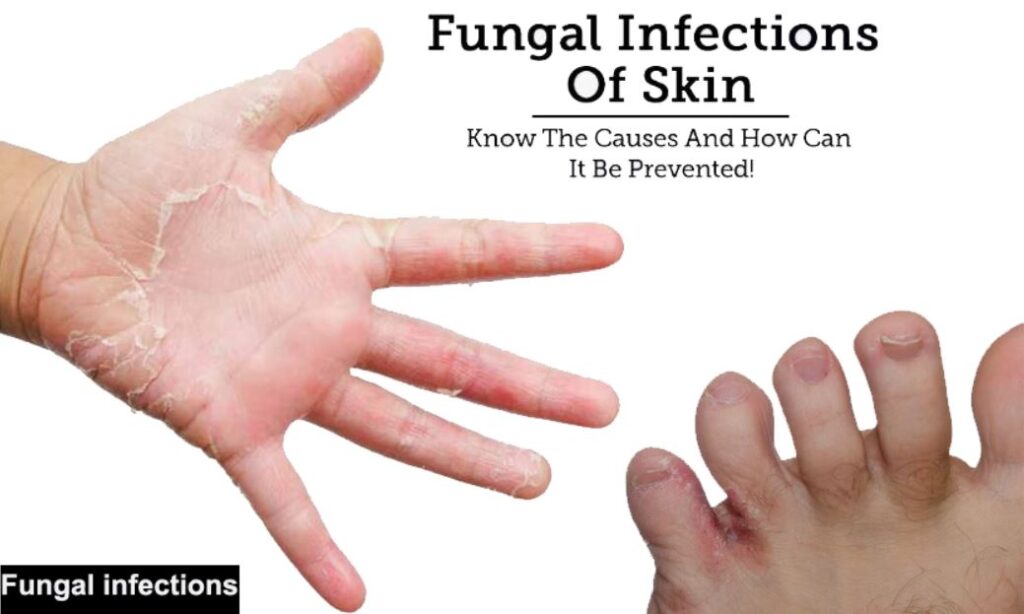 Fungal Infections